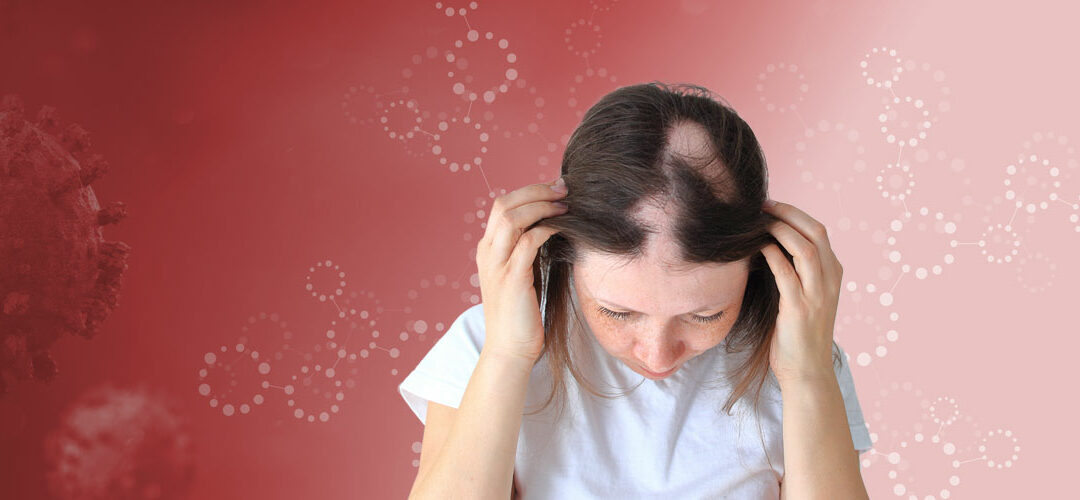Long Covid is now linked with hair loss in women